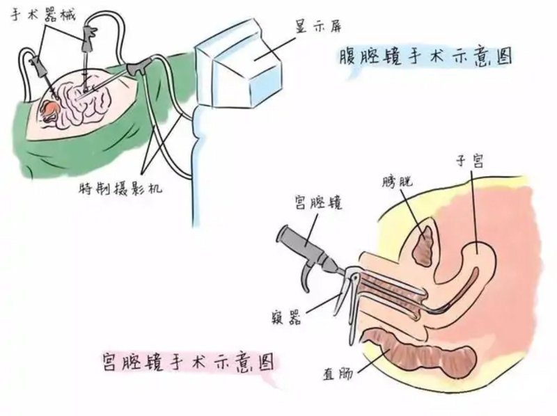 无痛分娩——让疼痛远离爱的旅程